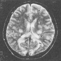 頭部MRI写真
